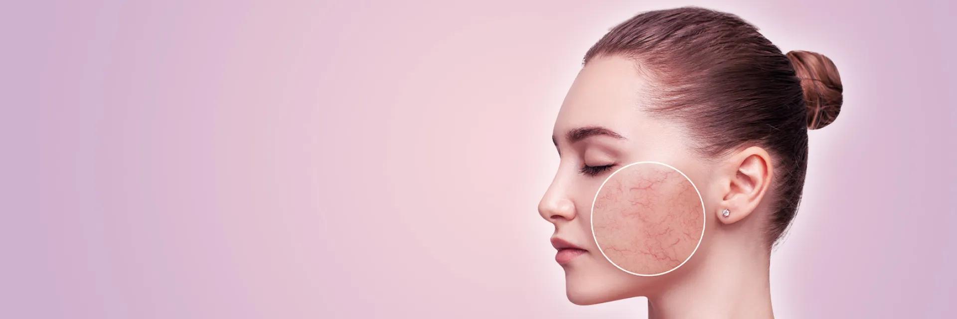 Rozacee – tratament laser Vbeam Perfecta si GentleMaxPro la DermaLife